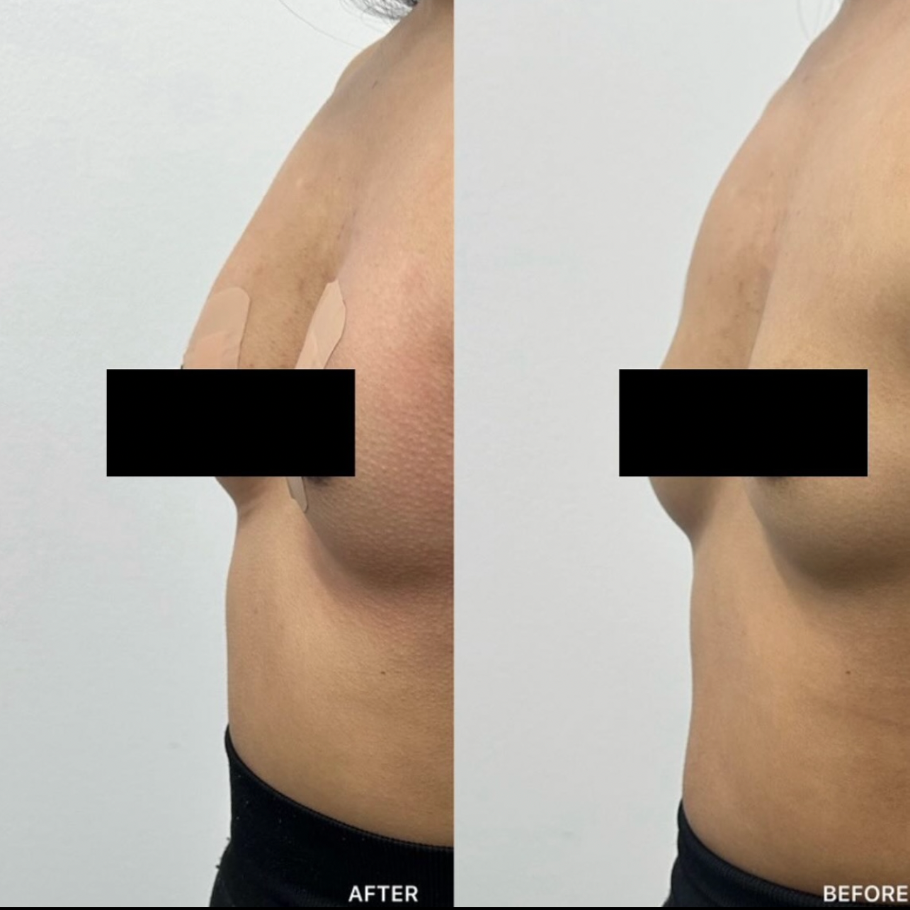 Breast Filler
