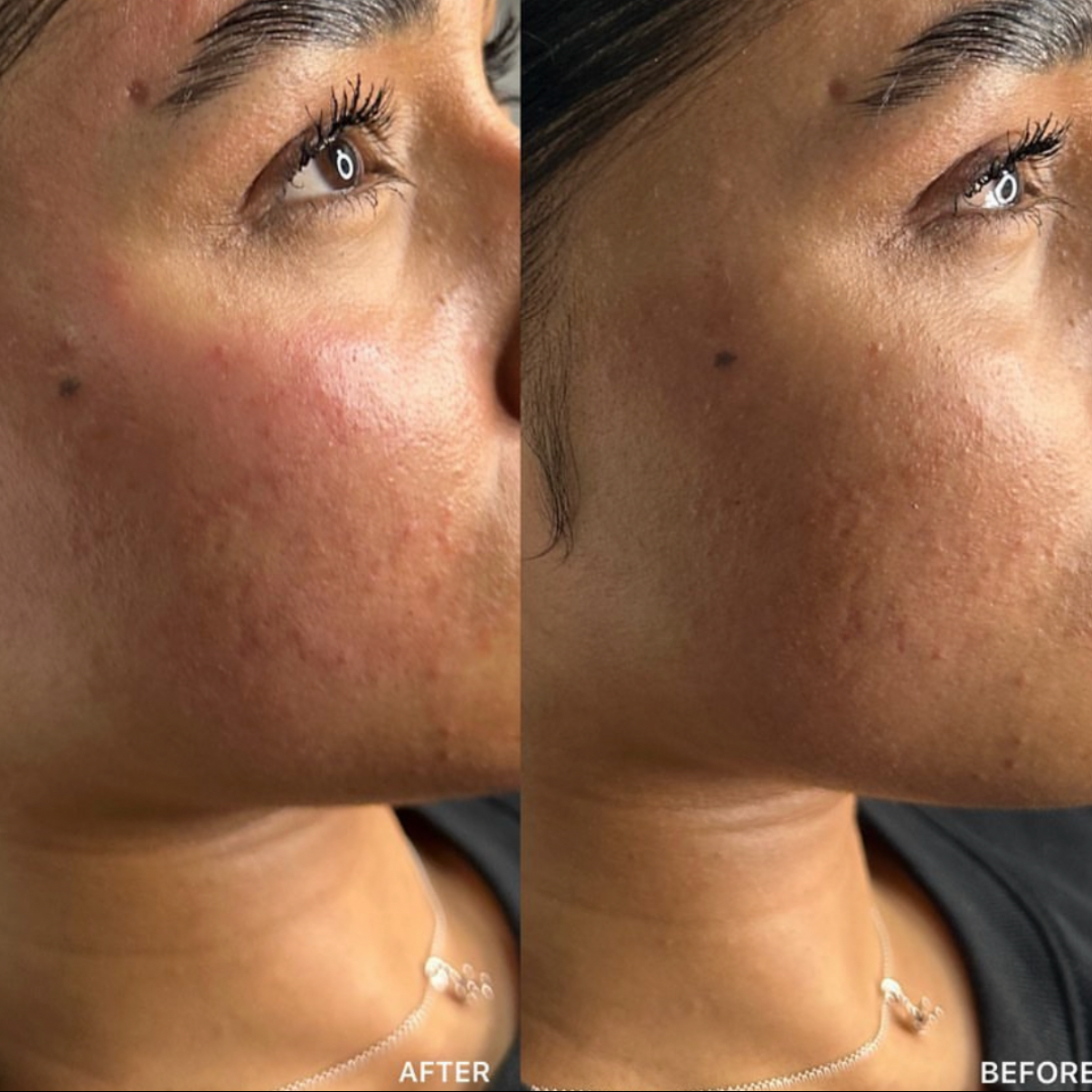 Dermaplaning & Microneedling