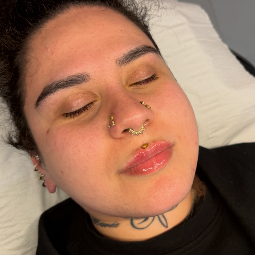 Russian / Natural Lip Filler