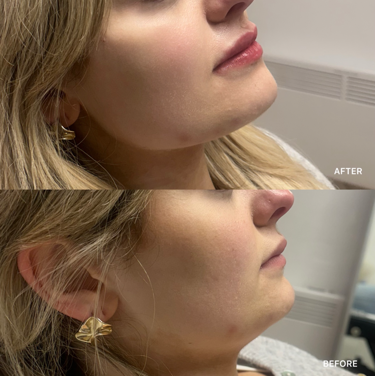 Jawline Filler