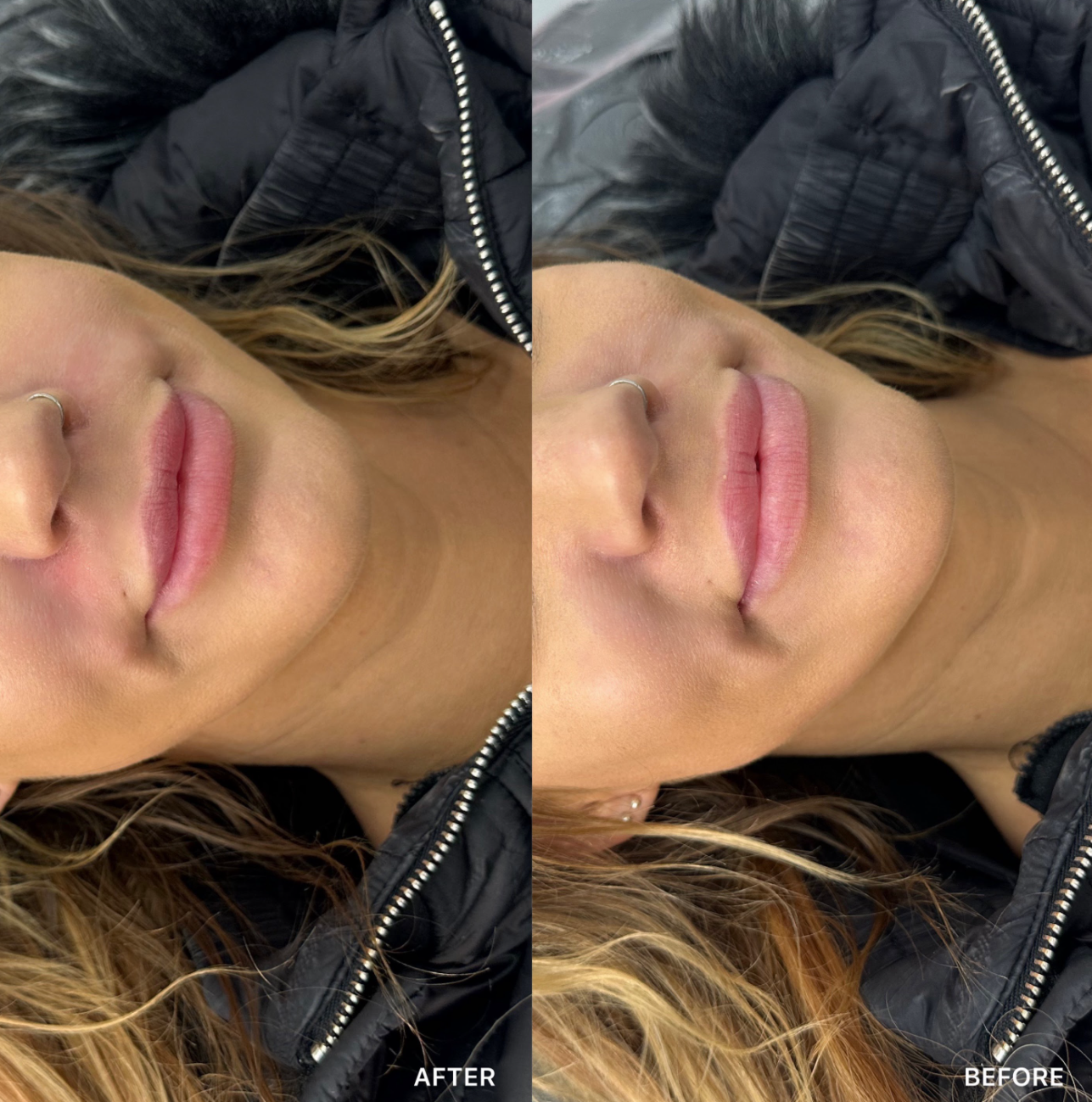 Smile Lines Filler