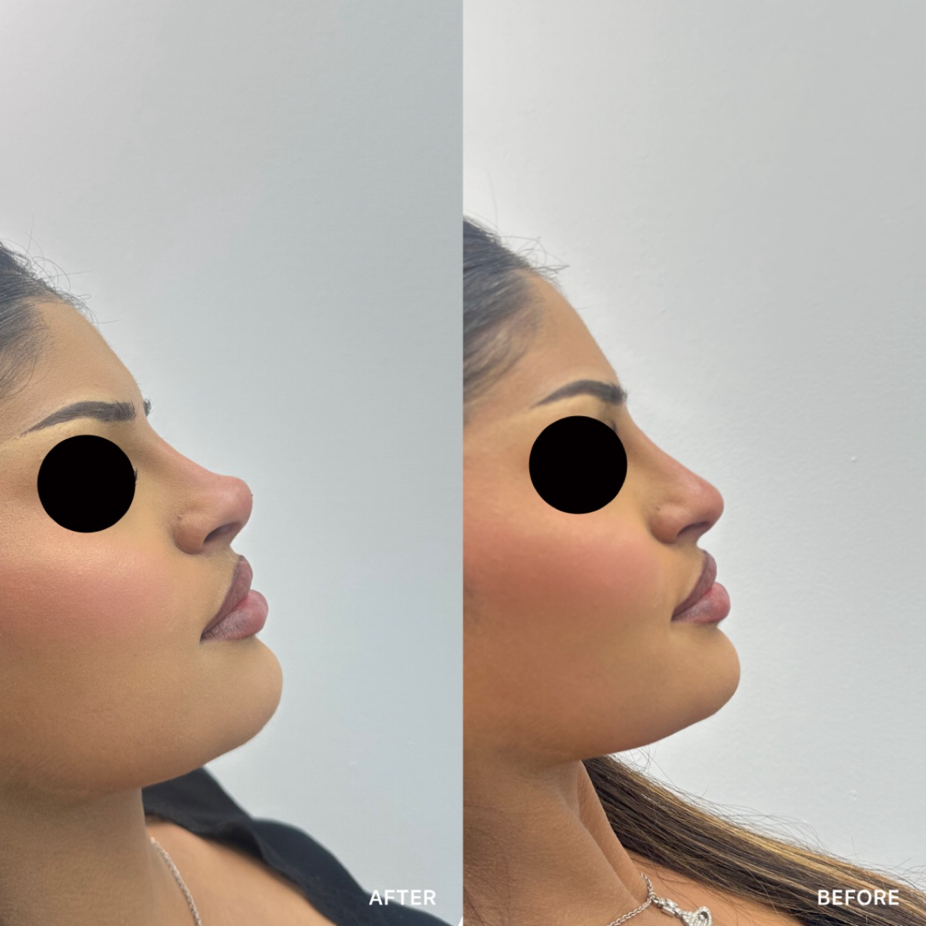 Non-Surgical Rhinoplasty