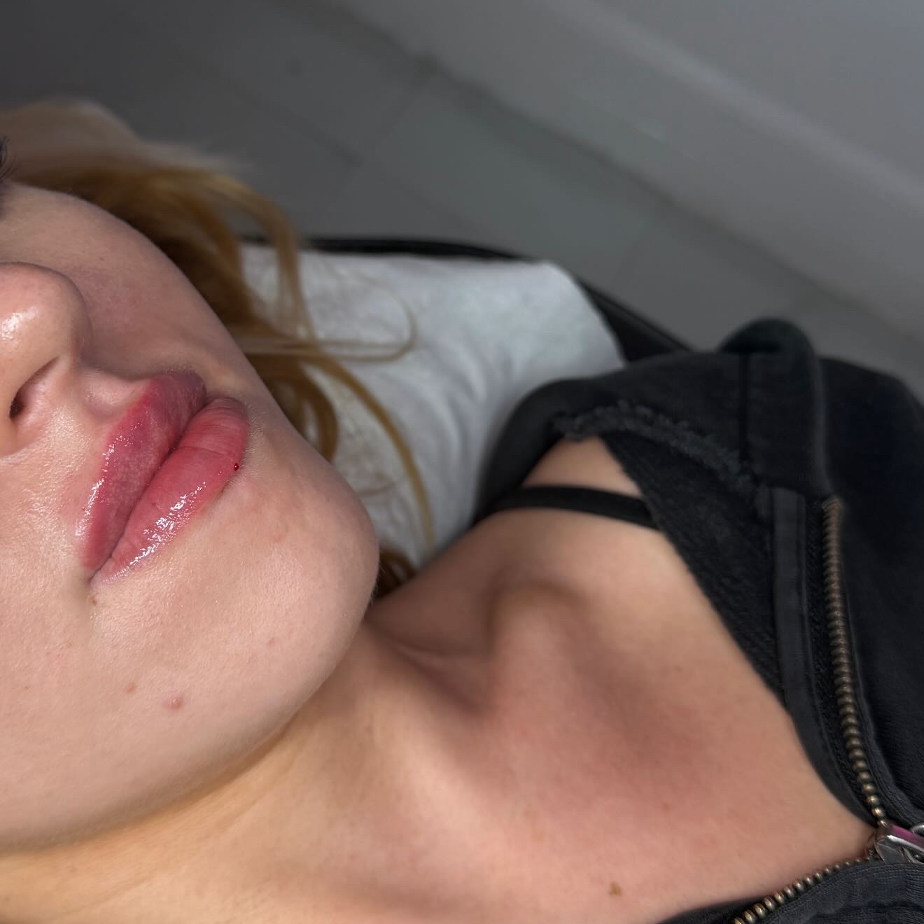 Russian / Natural Lip Filler