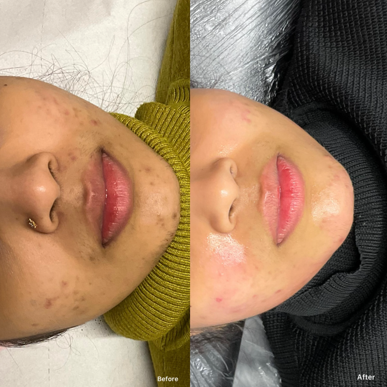 Dermaplaning & Microneedling