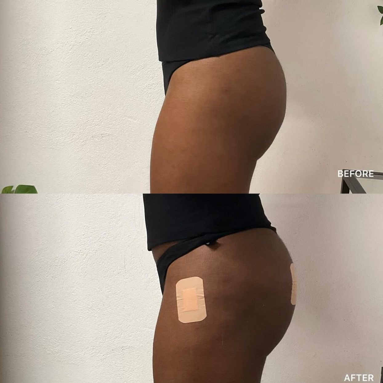 BBL and Hip Dip Filler