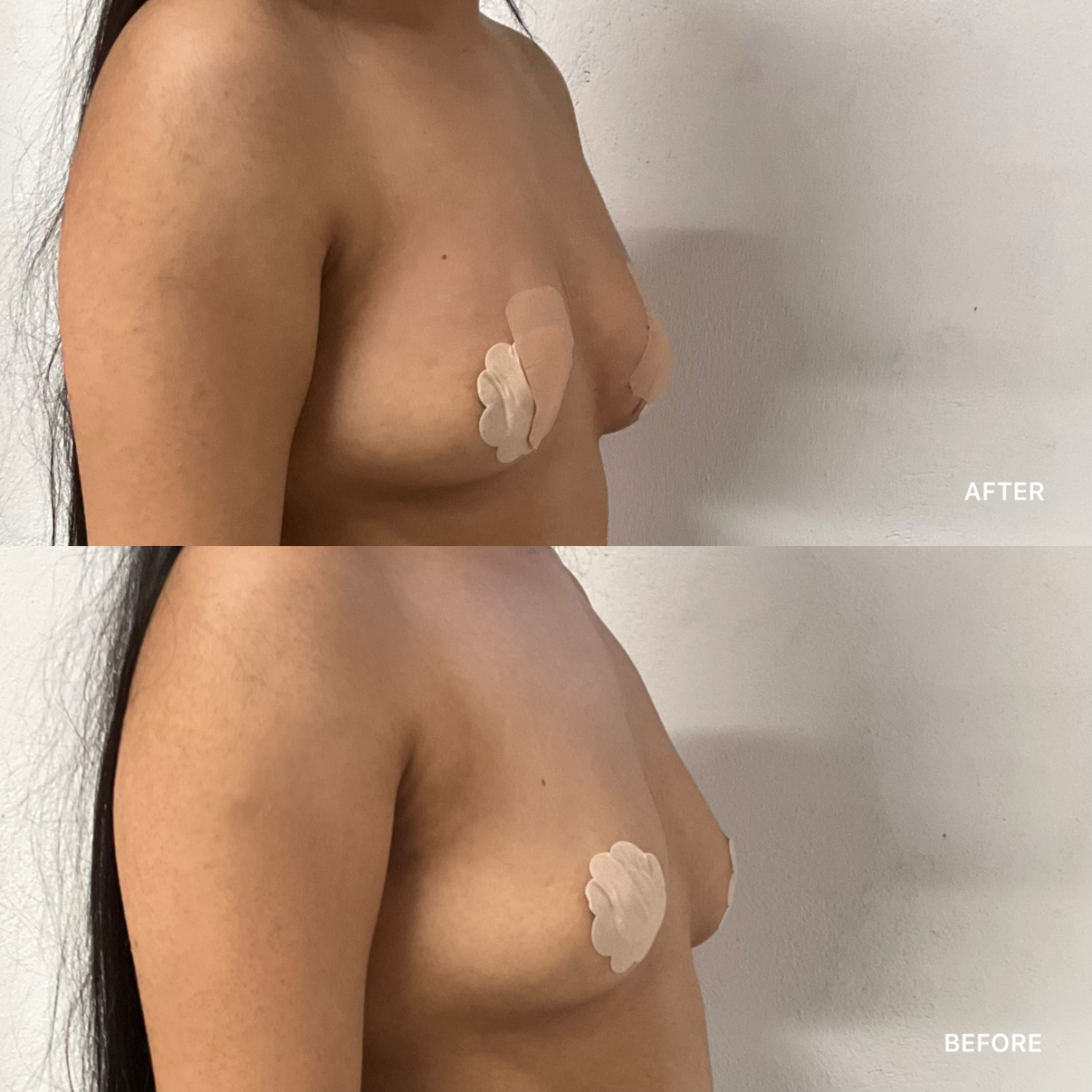 Breast Filler