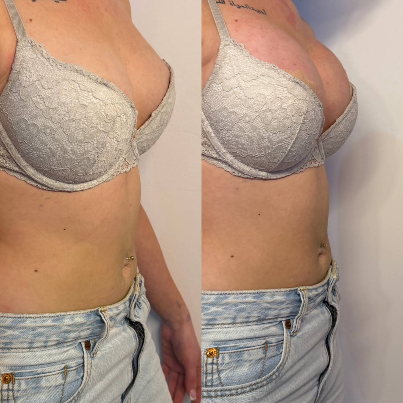 Breast Filler