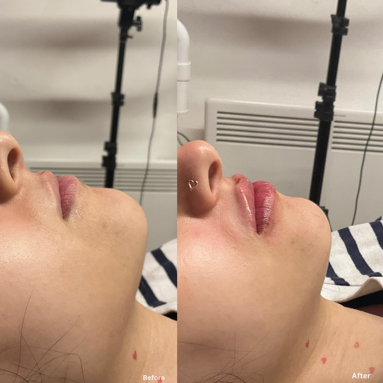 Russian / Natural Lip Filler