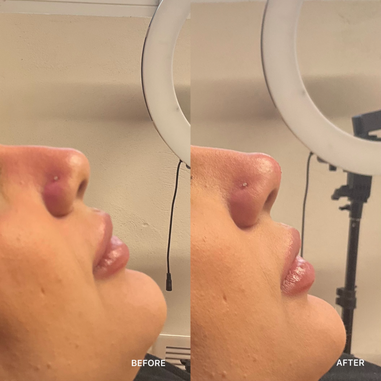 Non-Surgical Rhinoplasty