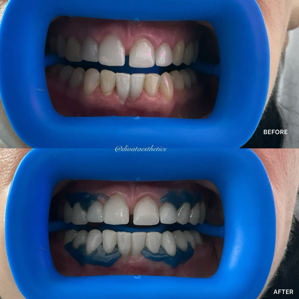 Teeth Whitening