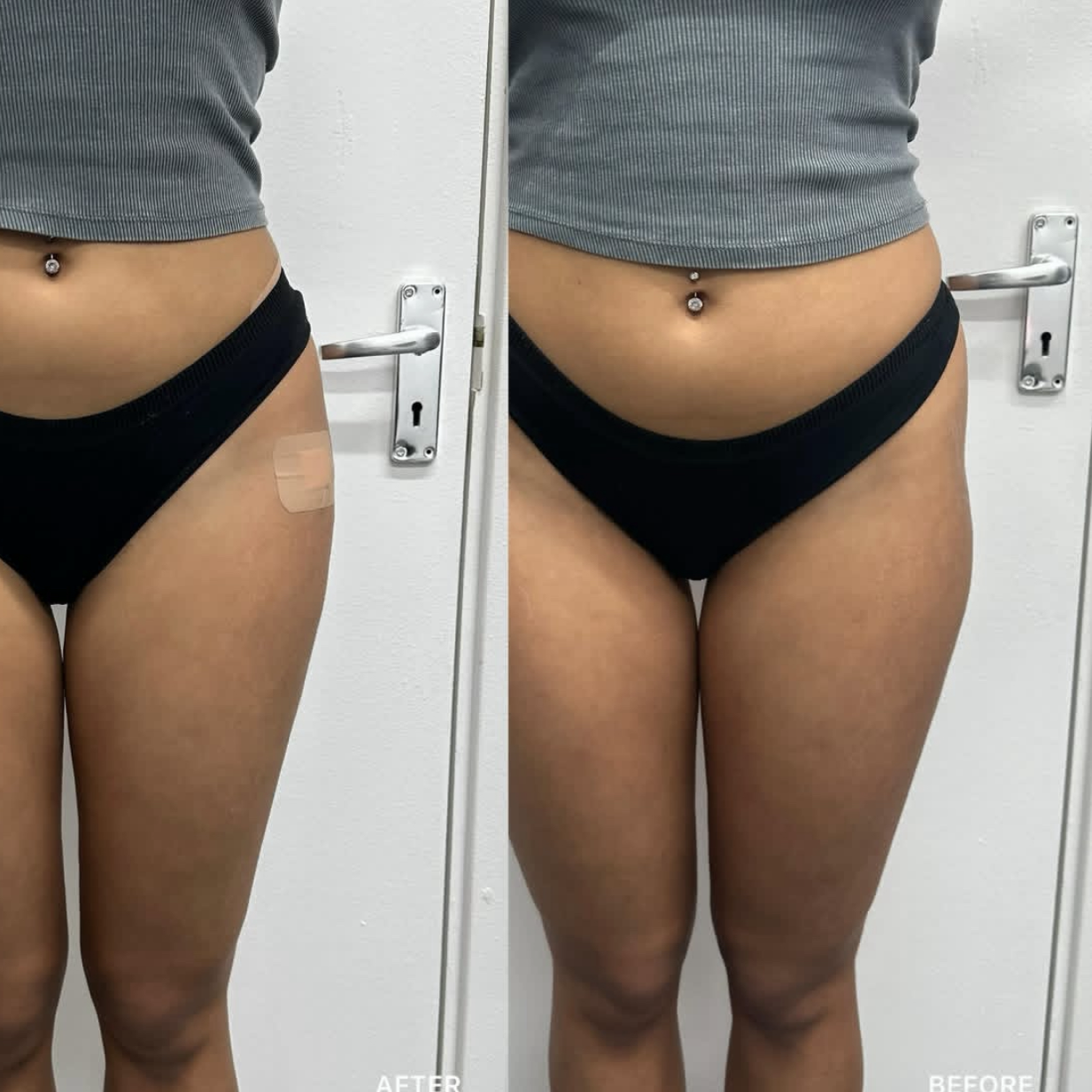BBL and Hip Dip Filler
