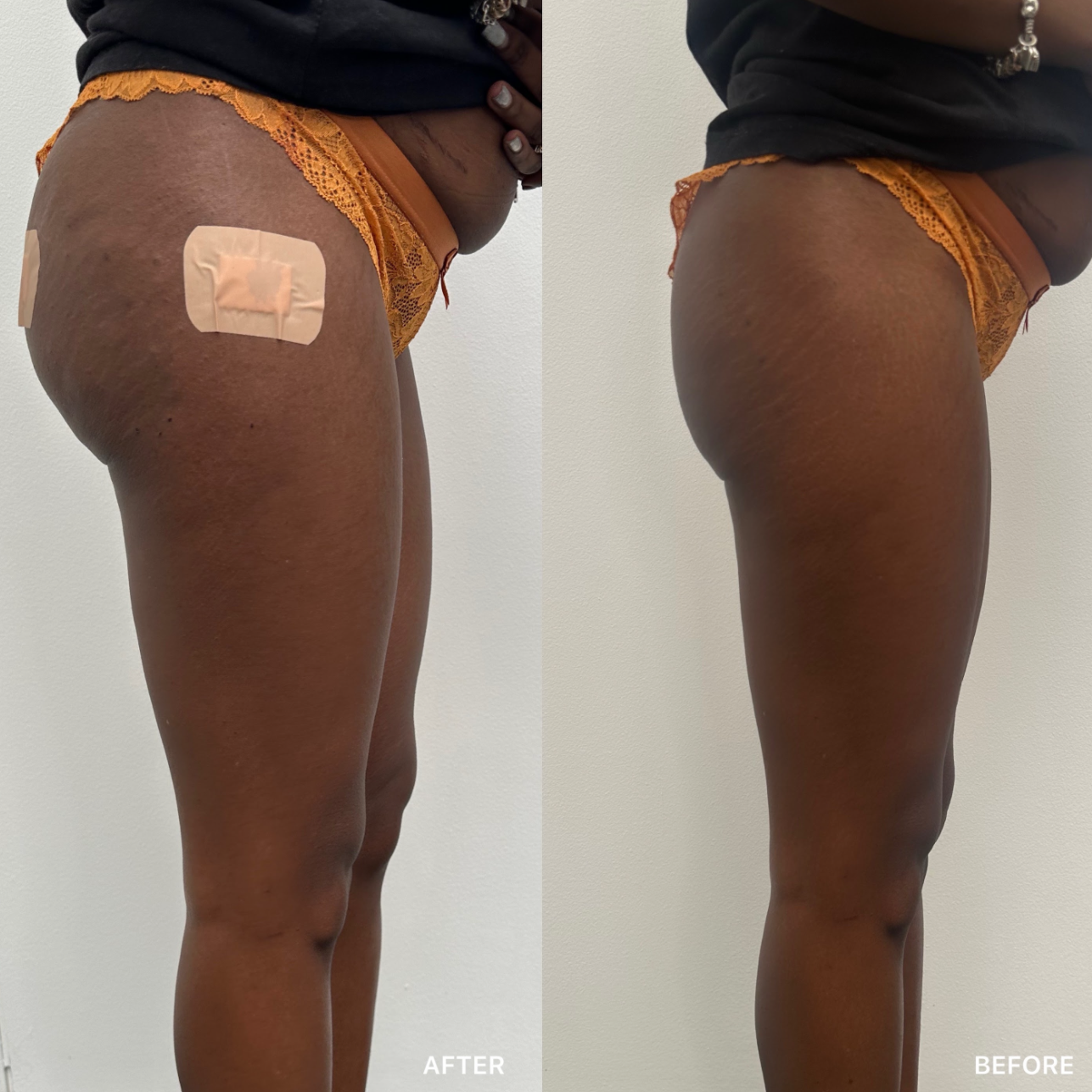 BBL and Hip Dip Filler