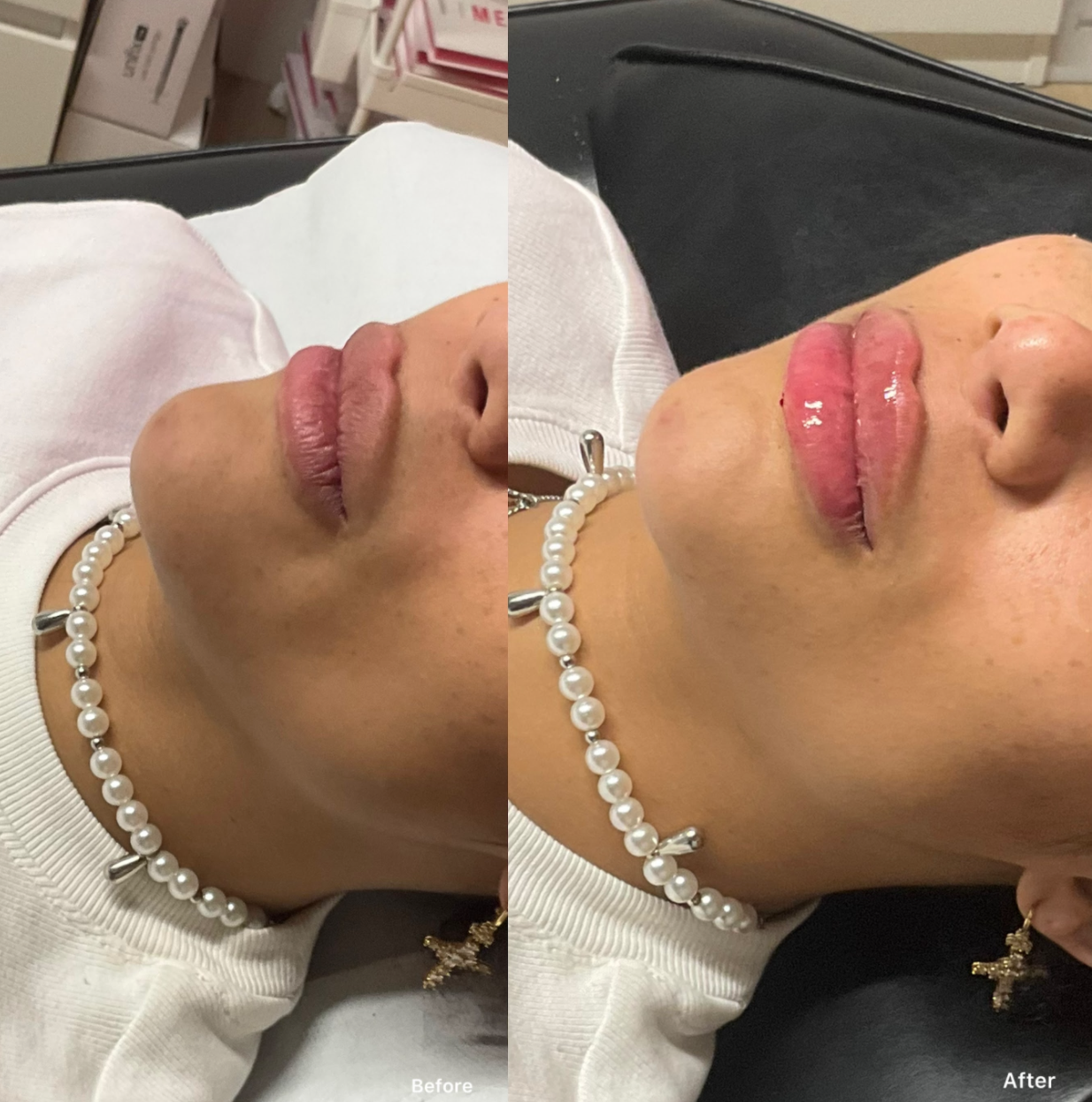 Russian / Natural Lip Filler