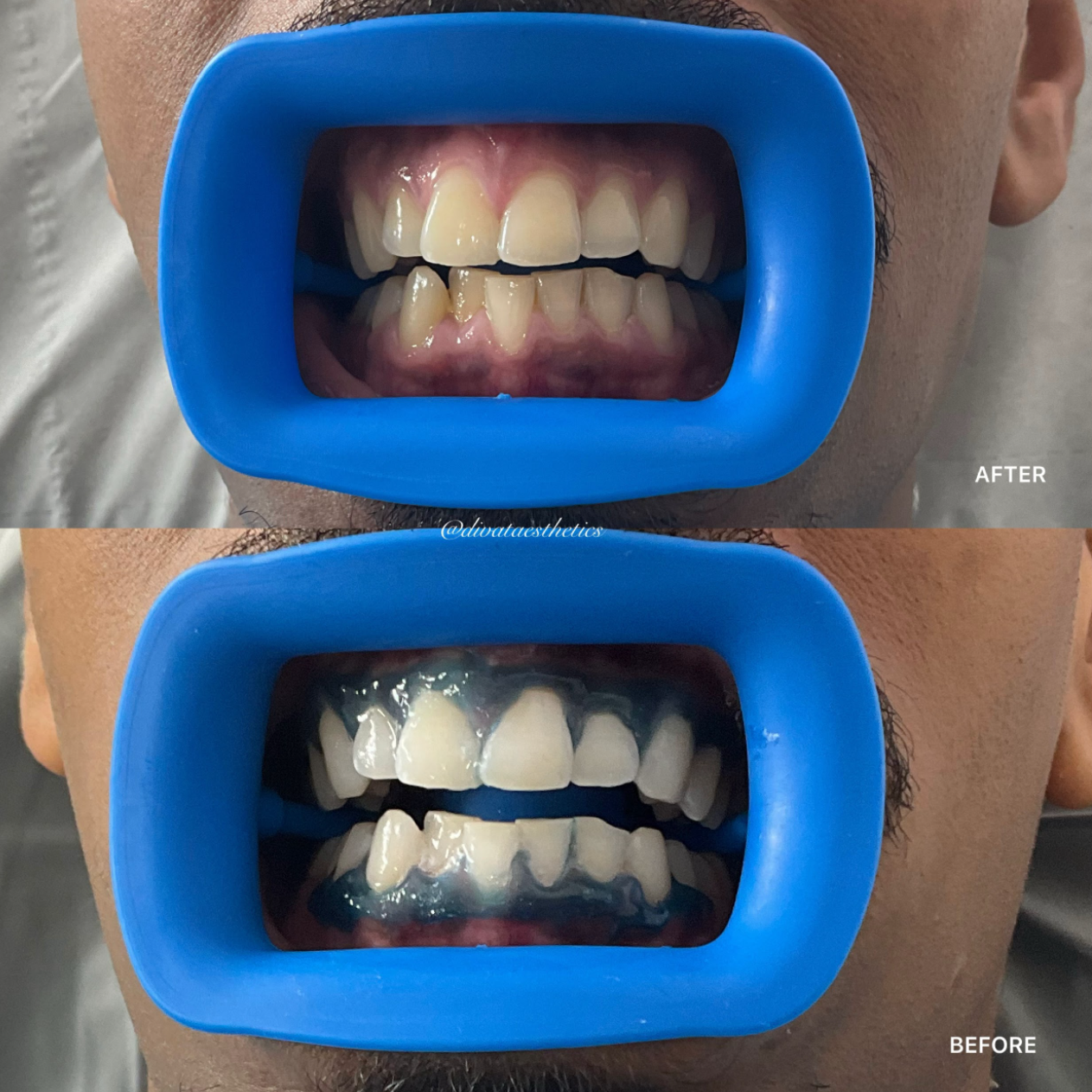 Teeth Whitening