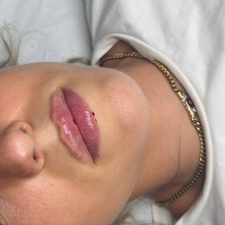 Russian / Natural Lip Filler