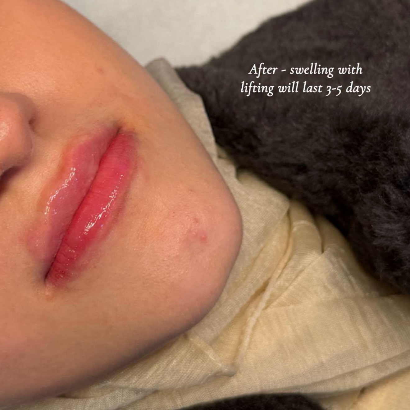 Russian / Natural Lip Filler