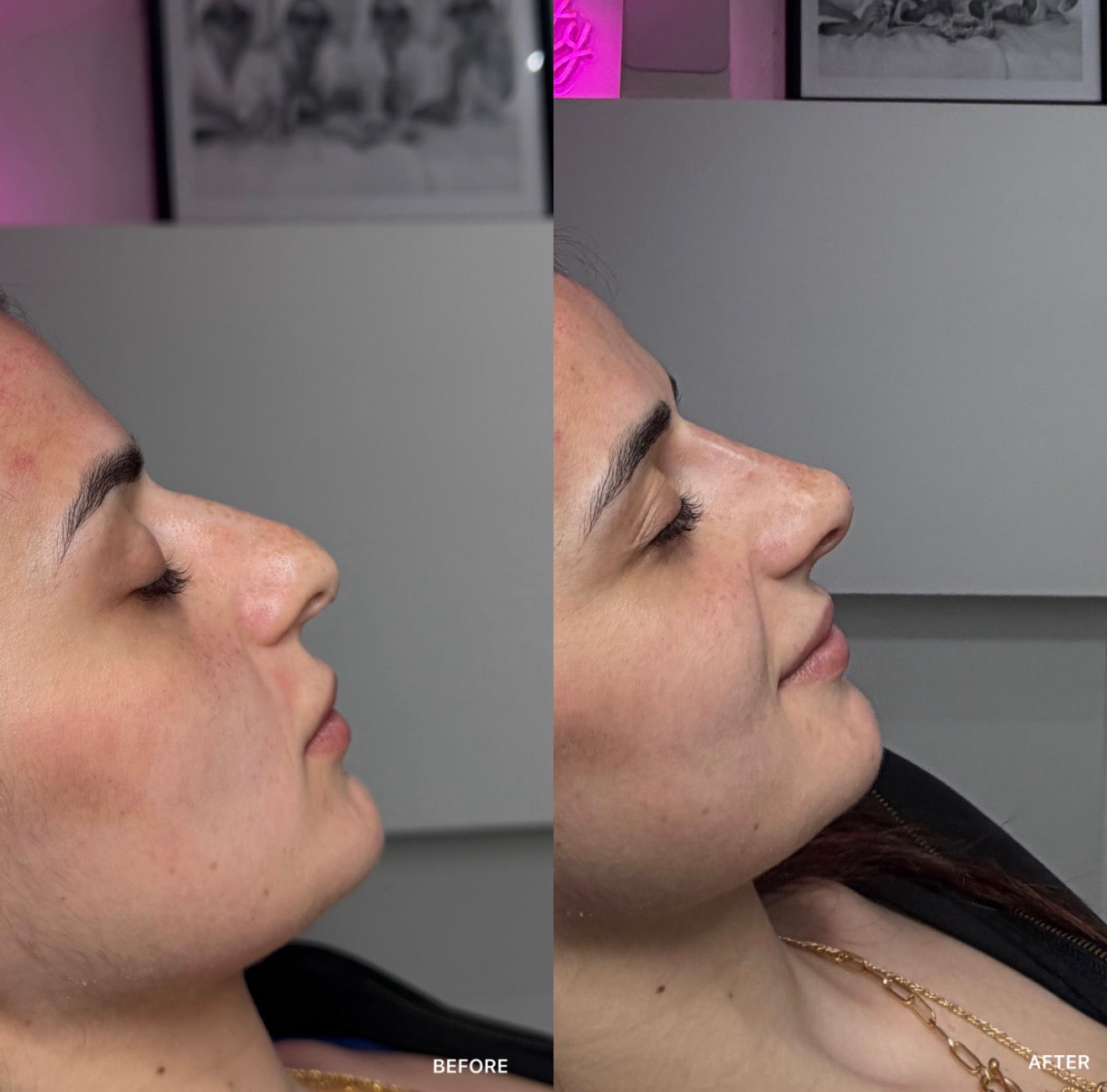 Non-Surgical Rhinoplasty