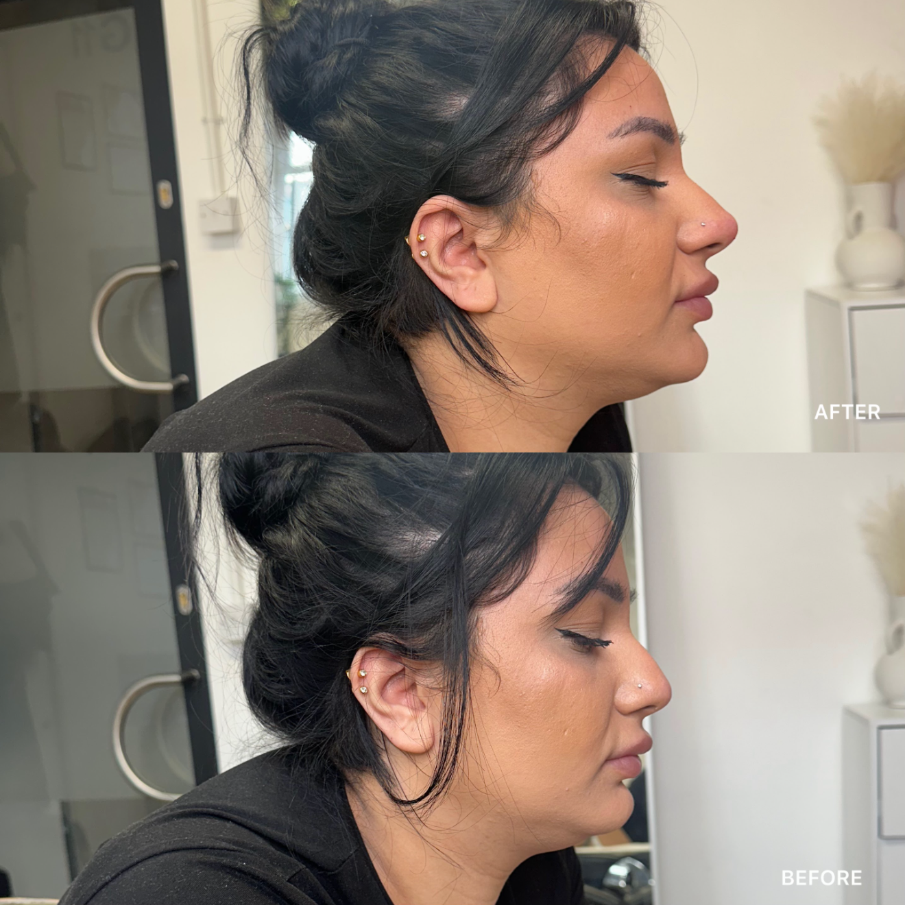 Non-Surgical Rhinoplasty