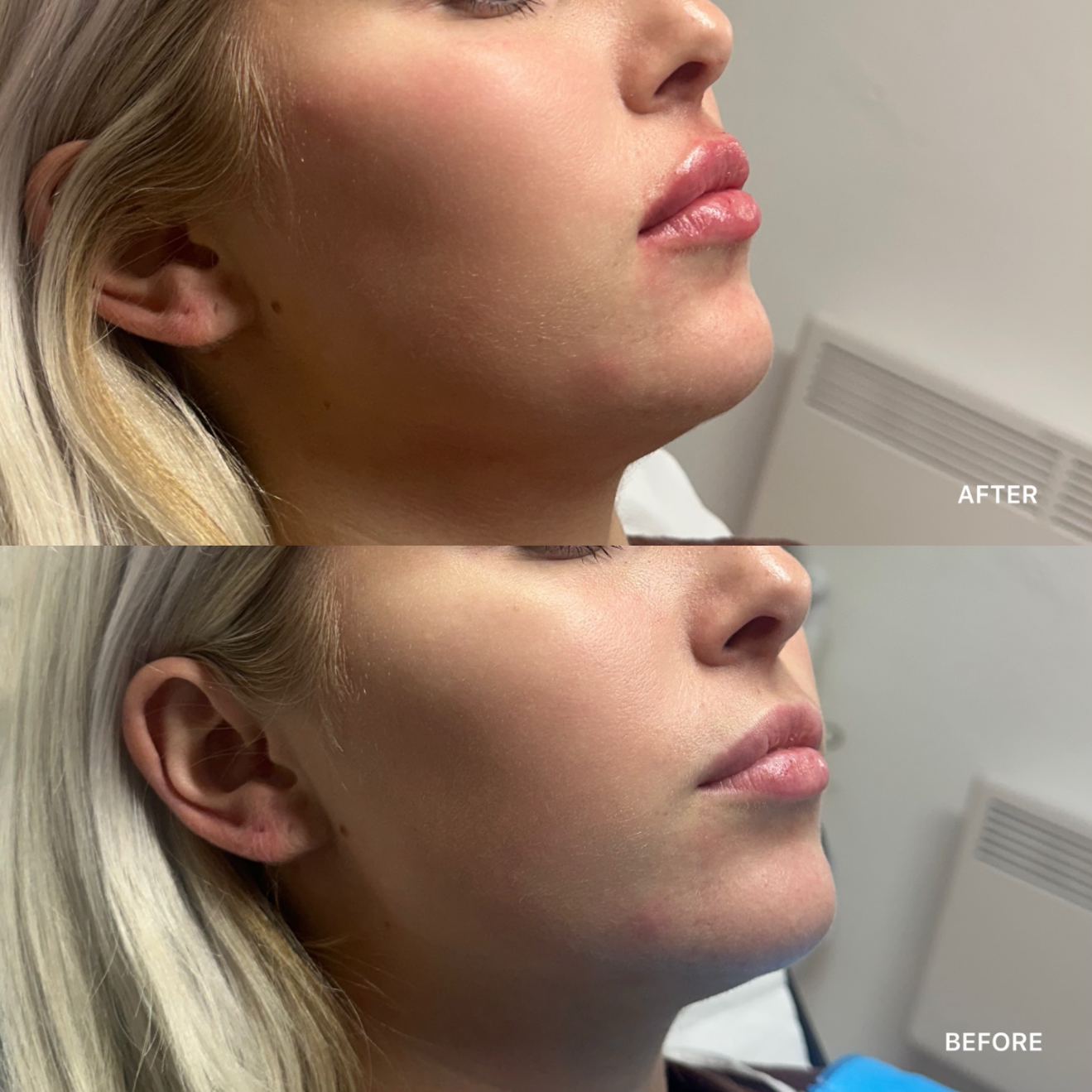 Cheek Filler