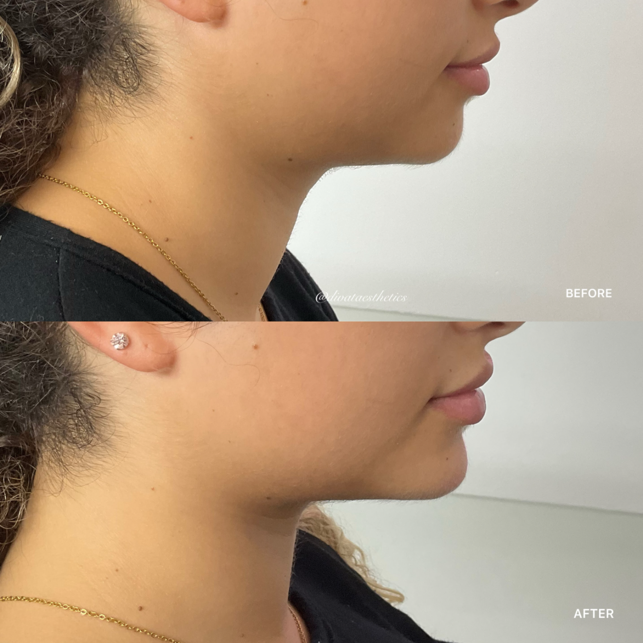 Chin Filler