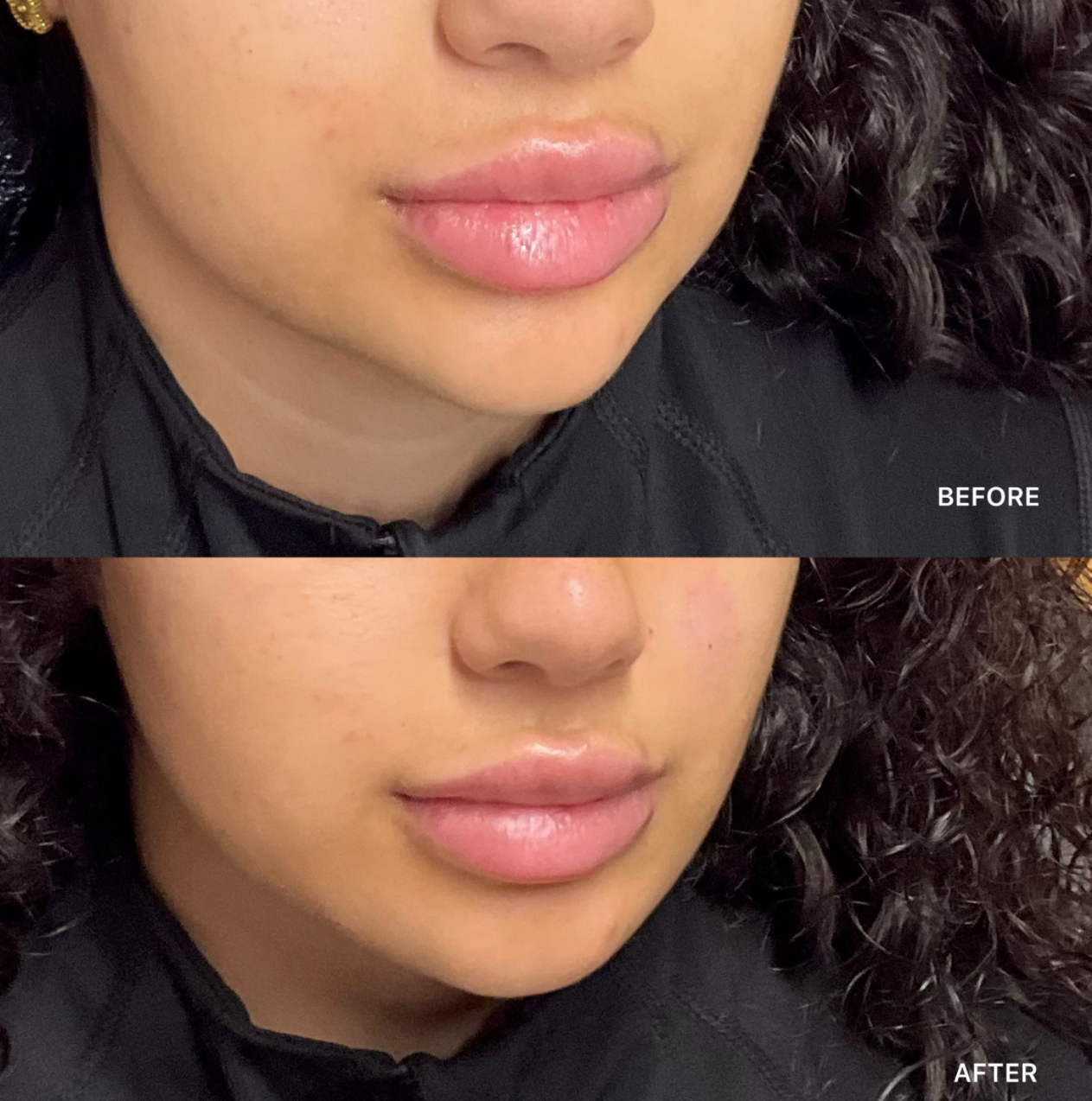Jawline Filler