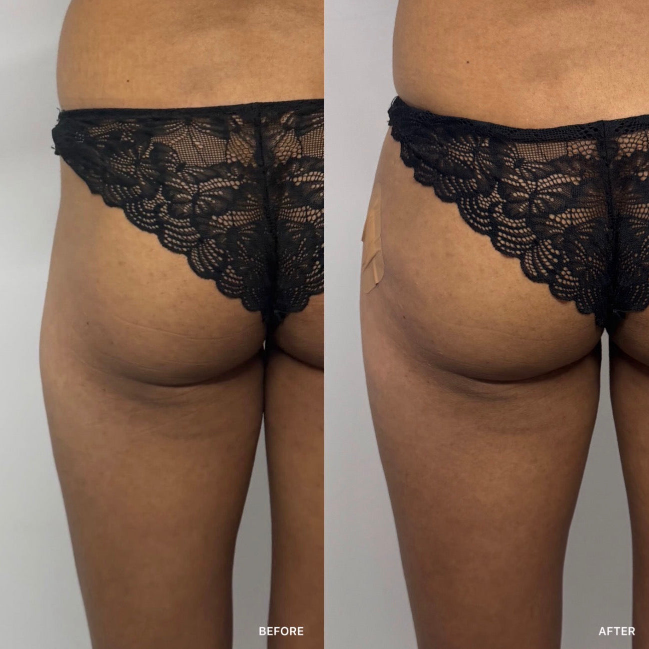 BBL and Hip Dip Filler
