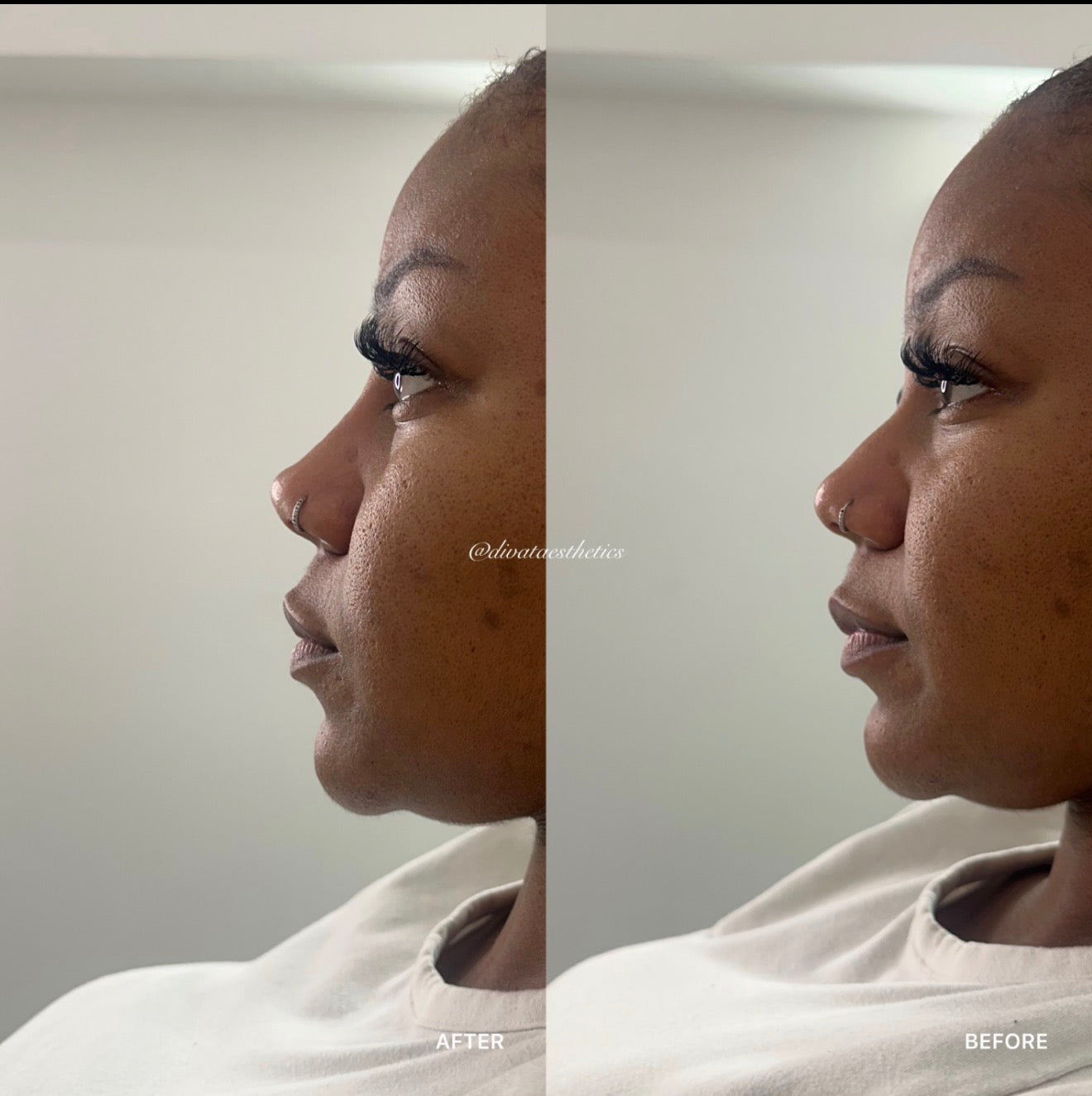 Non-Surgical Rhinoplasty