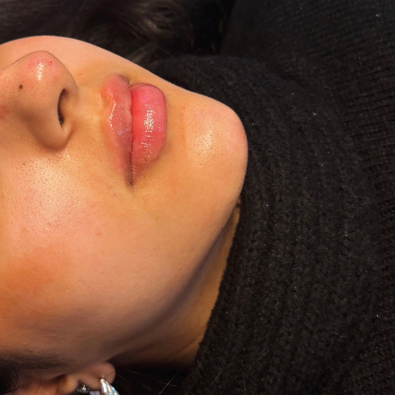 Russian / Natural Lip Filler