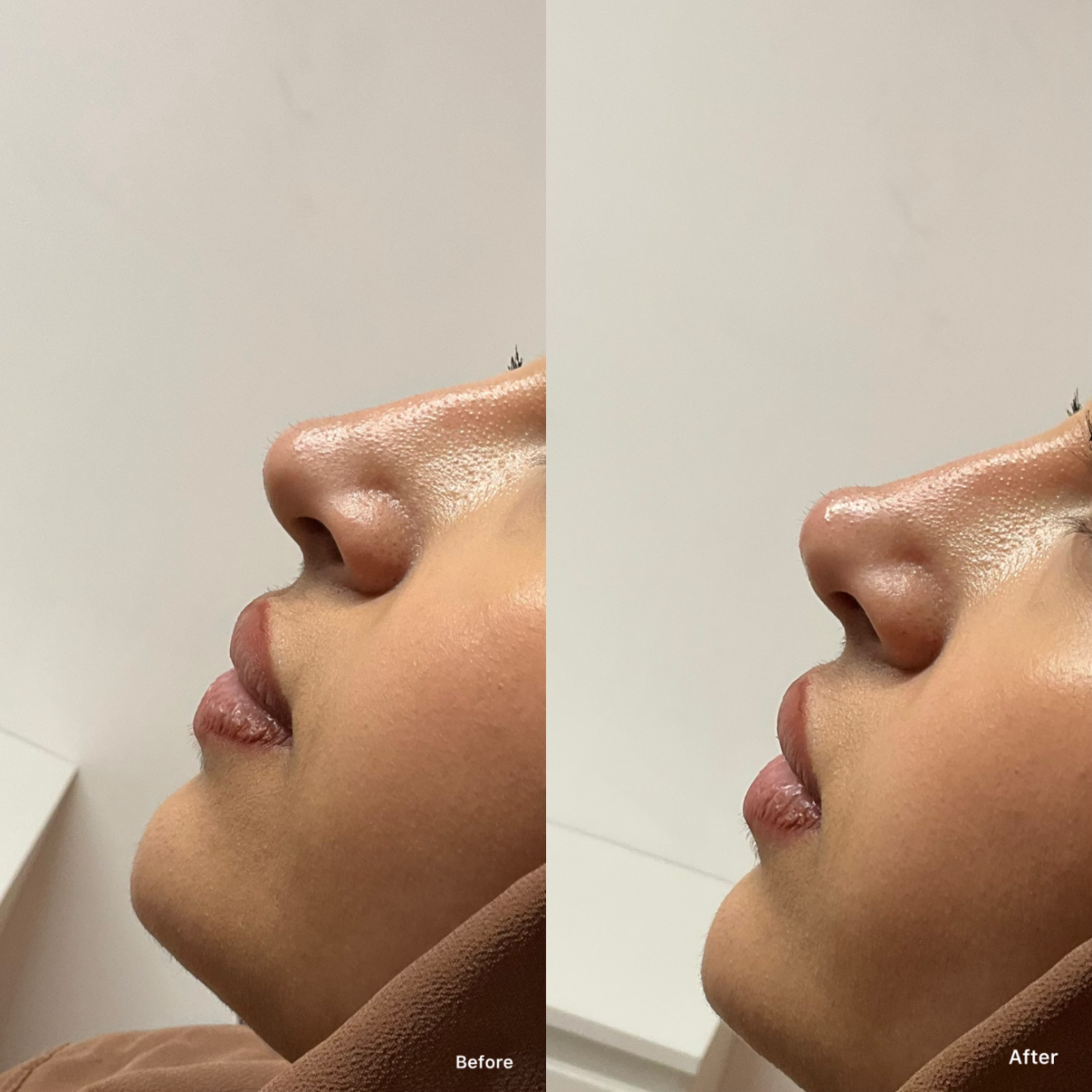 Nose Filler Aftercare: Non-Surgical Rhinoplasty Healing Guide