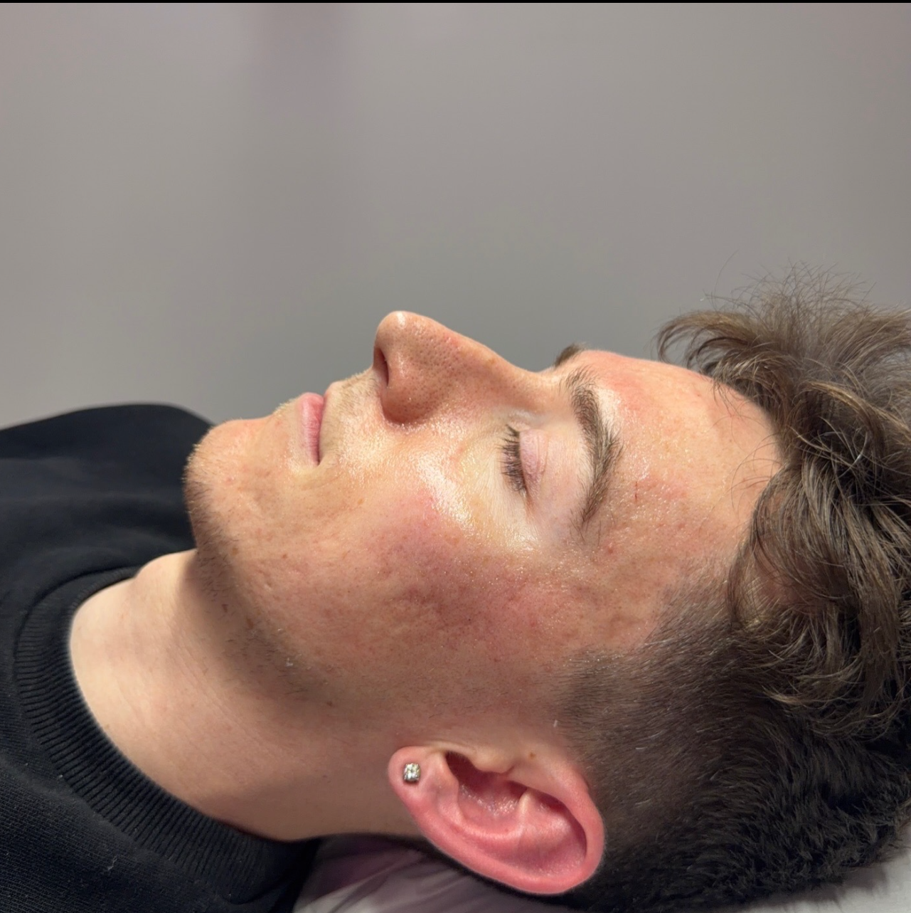 Microneedling & Dermaplaning Aftercare: What to Expect & How to Care for Your Skin