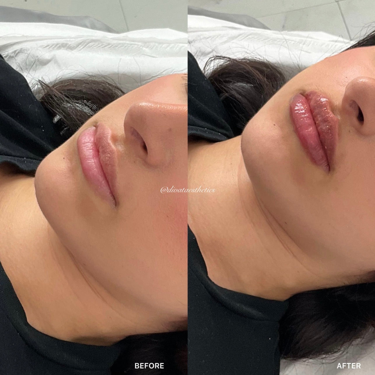 Russian / Natural Lip Filler