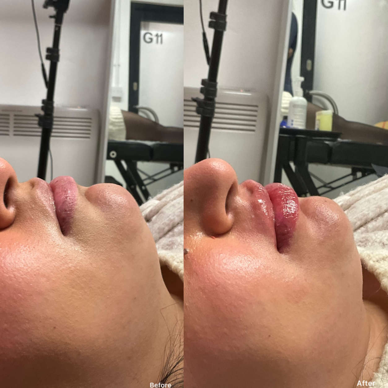 Russian / Natural Lip Filler