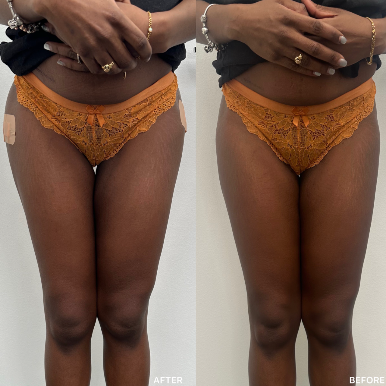 BBL and Hip Dip Filler