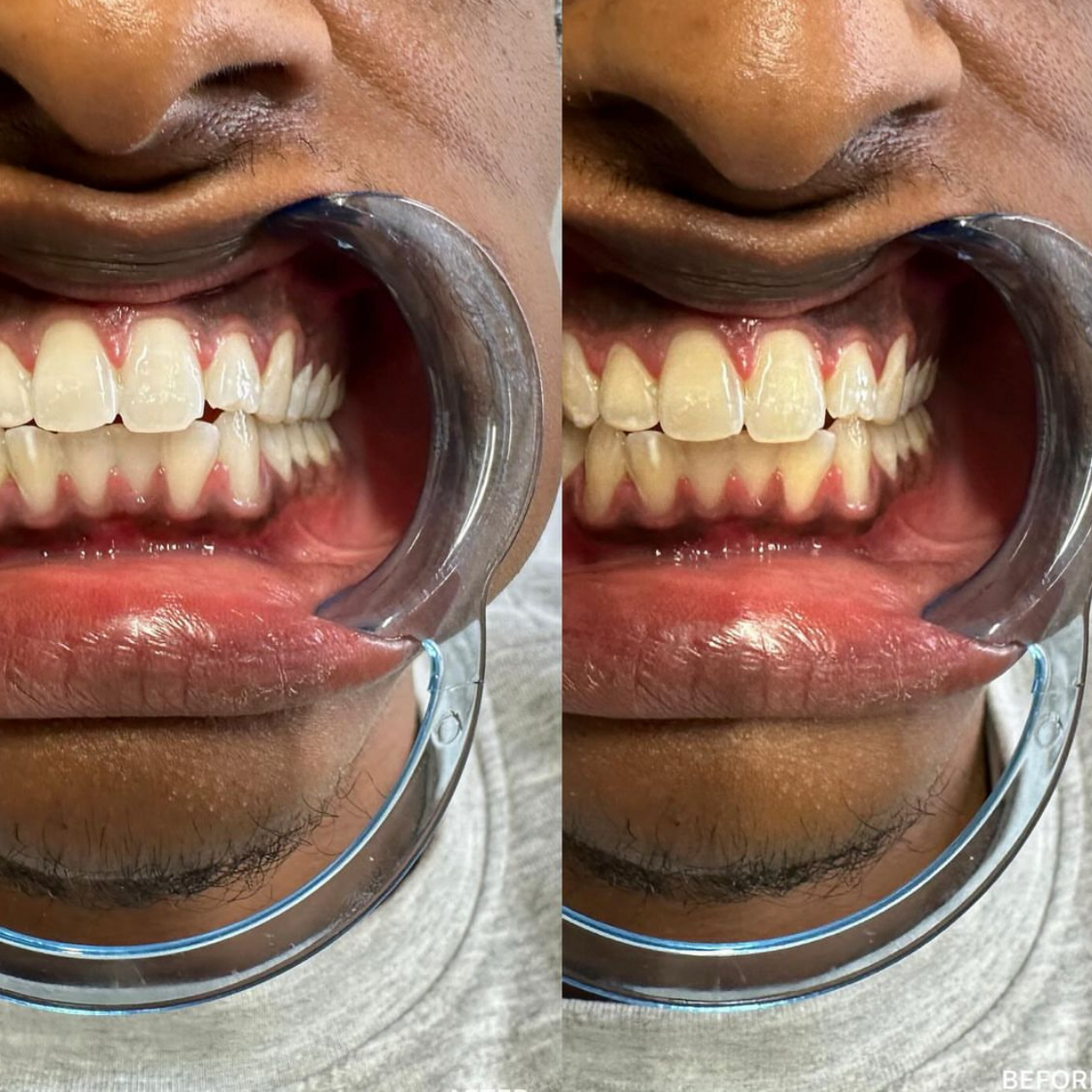 Teeth Whitening