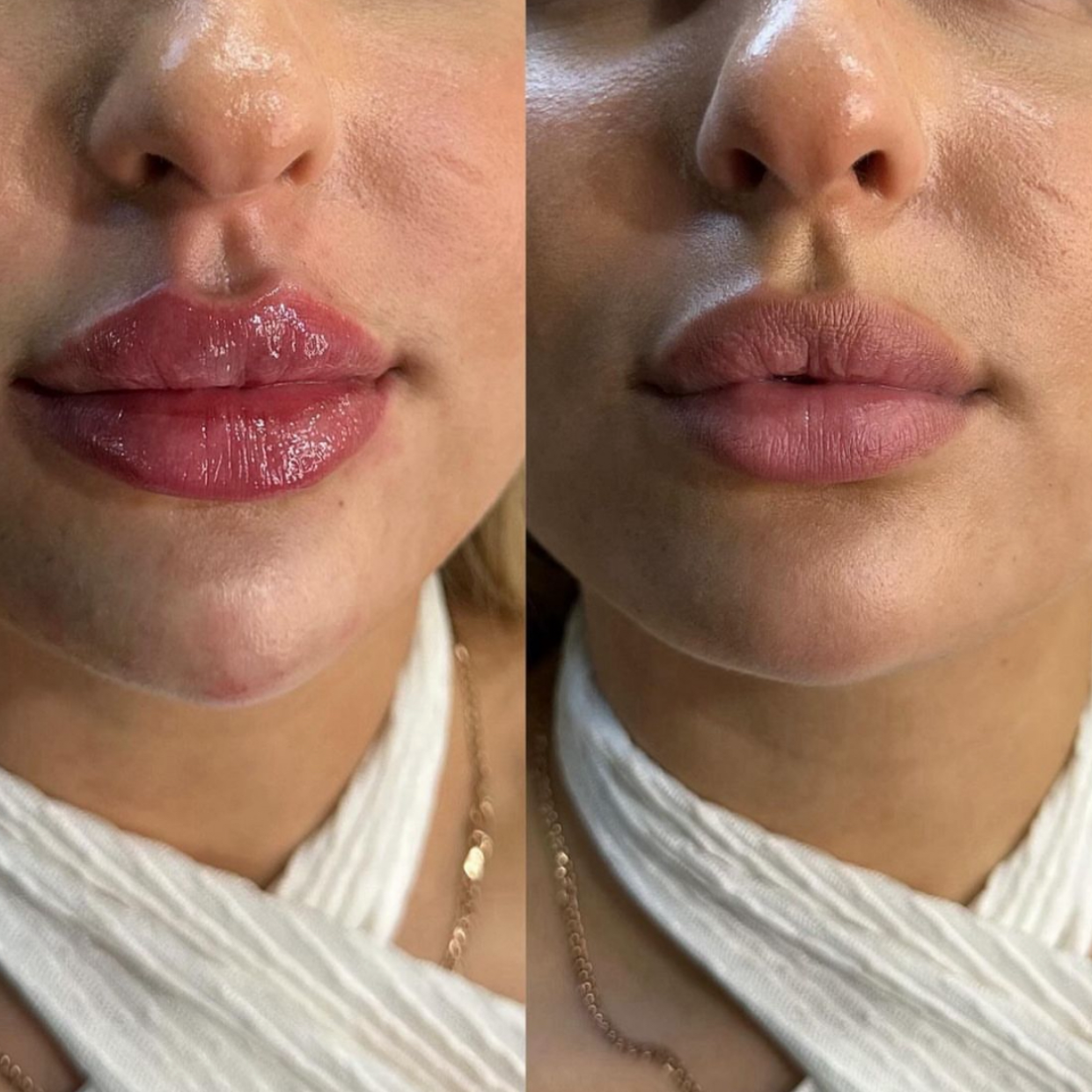 Russian / Natural Lip Filler