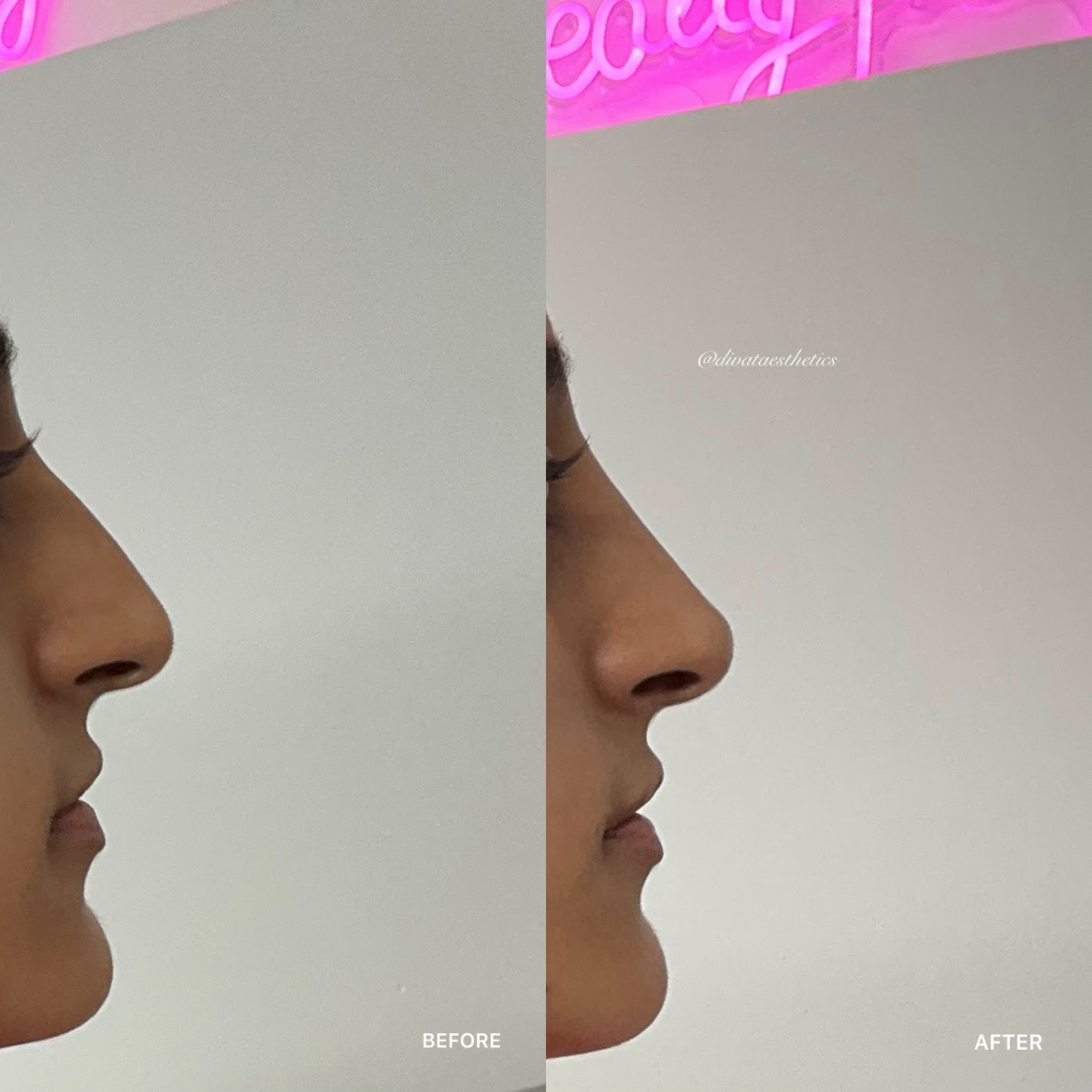 Non-Surgical Rhinoplasty