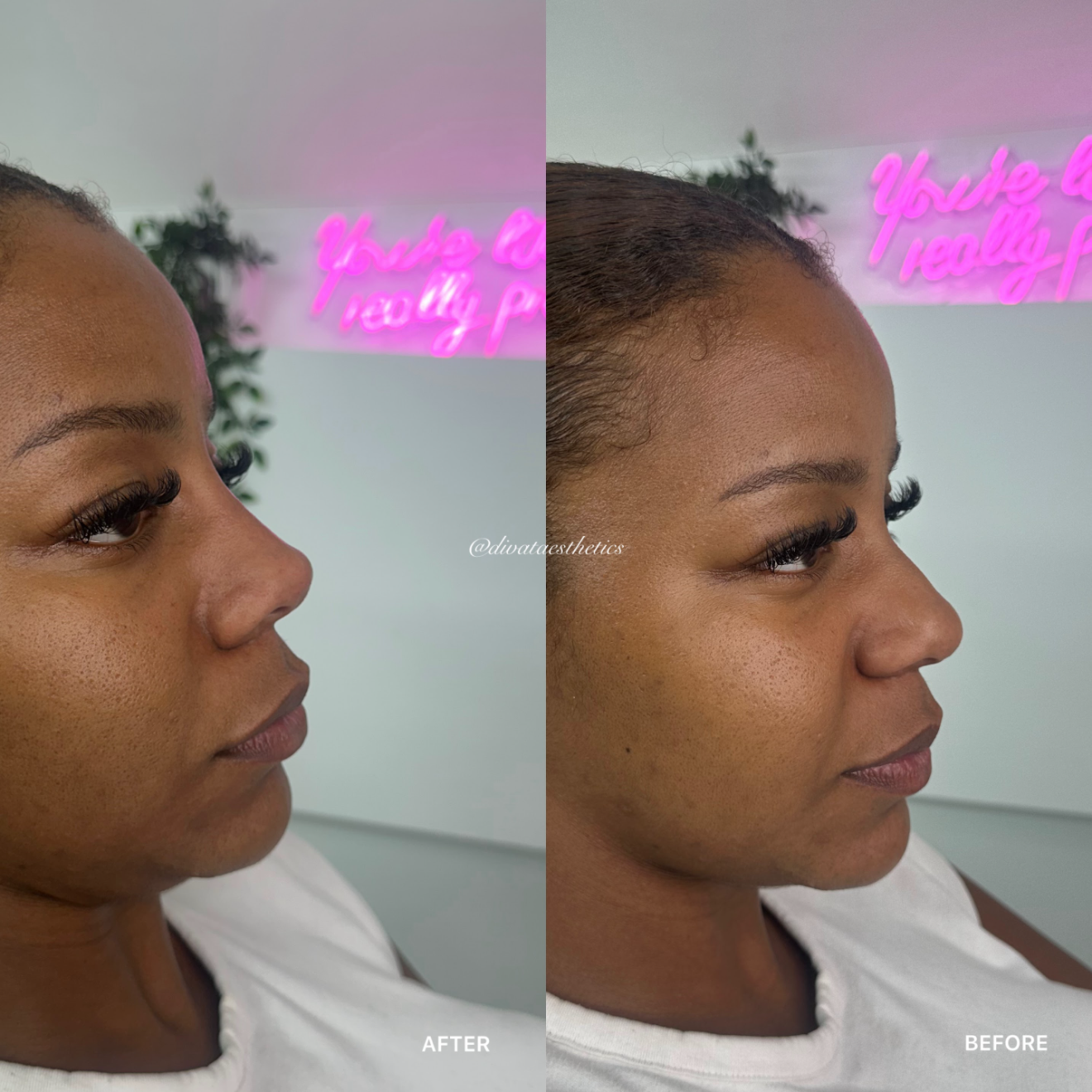Non-Surgical Rhinoplasty