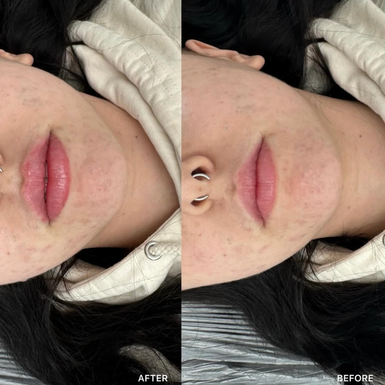 Russian / Natural Lip Filler