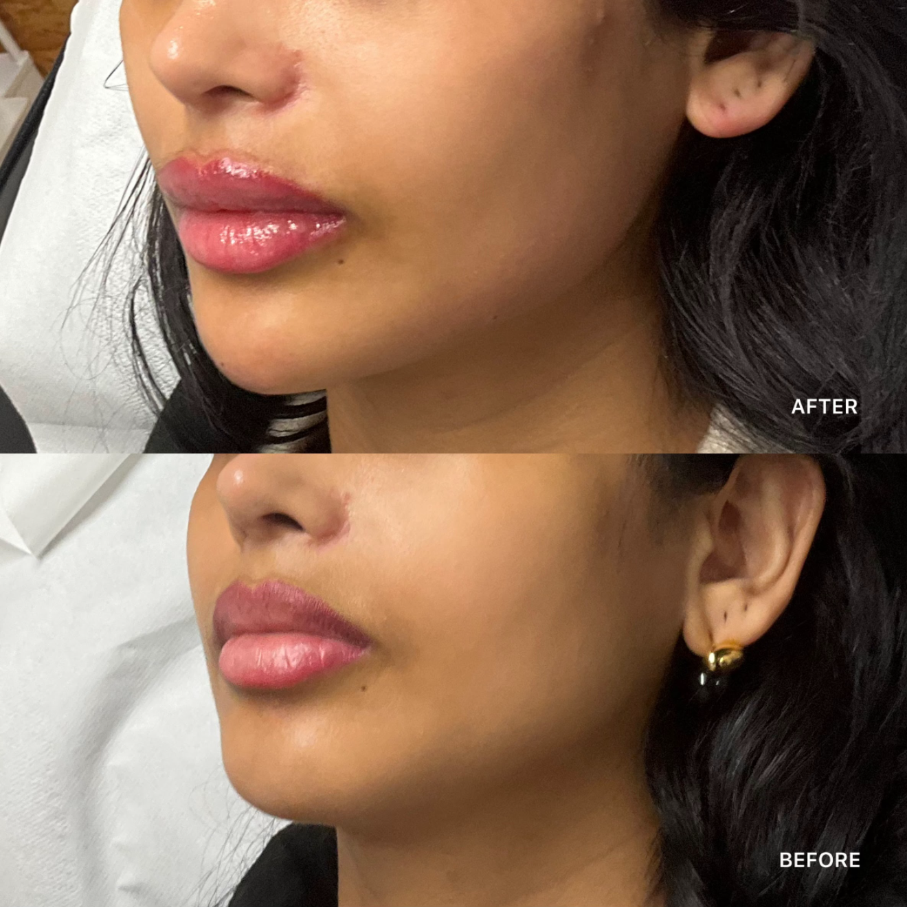 Jawline Filler