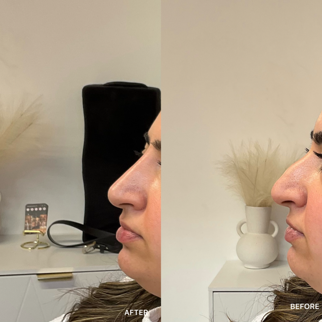 Non-Surgical Rhinoplasty