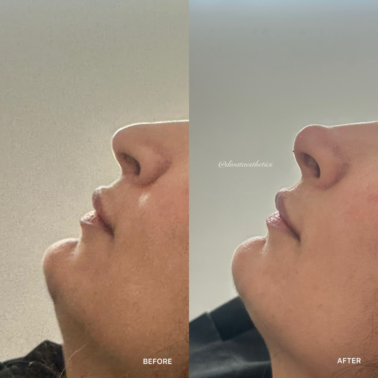 Non-Surgical Rhinoplasty