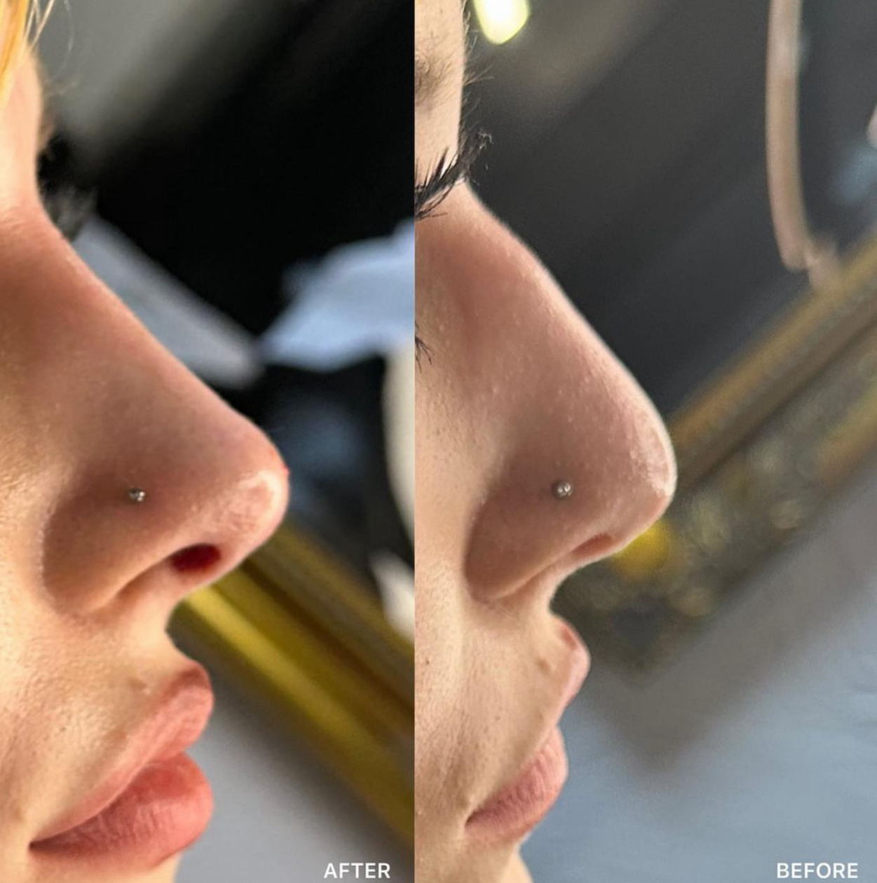 Non-Surgical Rhinoplasty