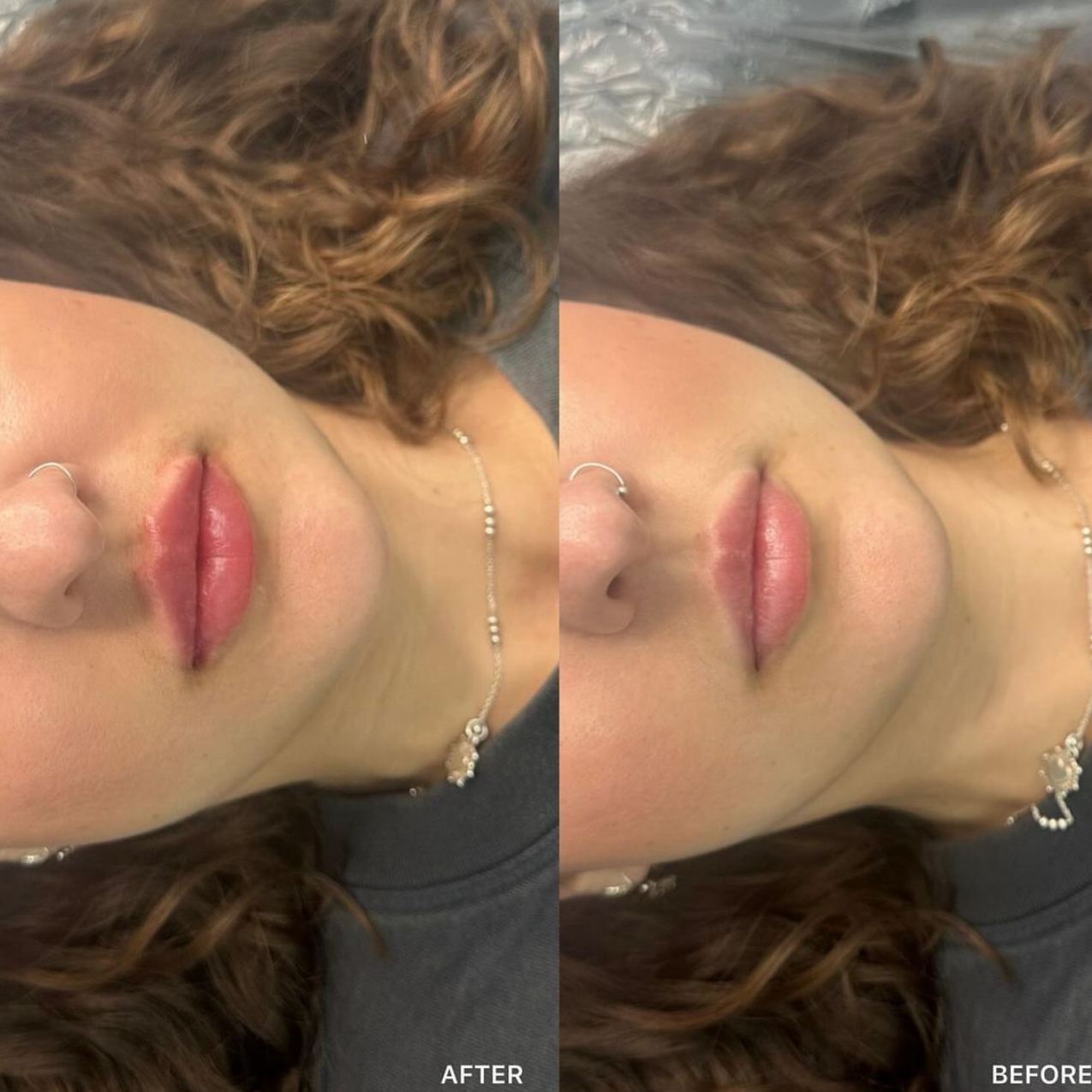 Russian / Natural Lip Filler