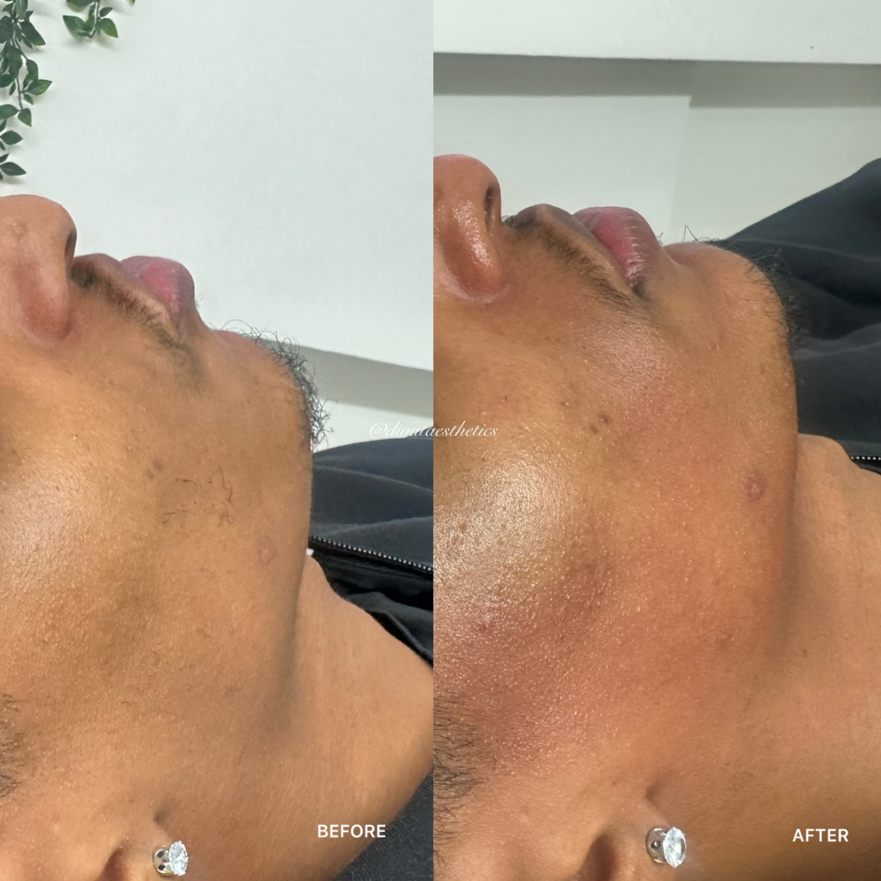 Dermaplaning & Microneedling