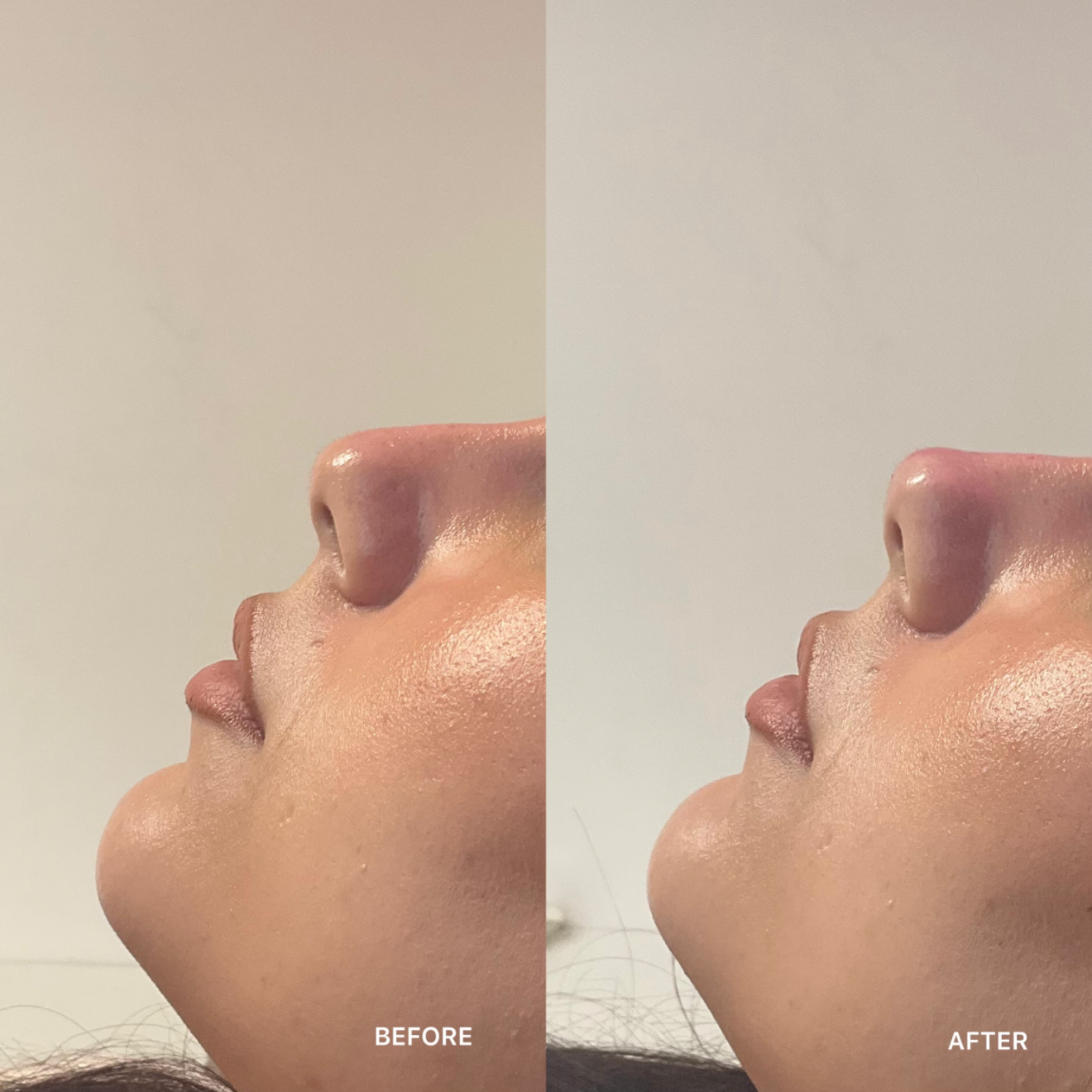 Non-Surgical Rhinoplasty