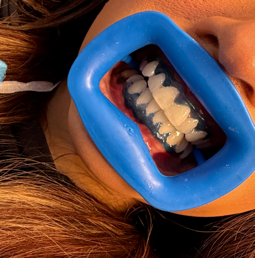 Teeth Whitening