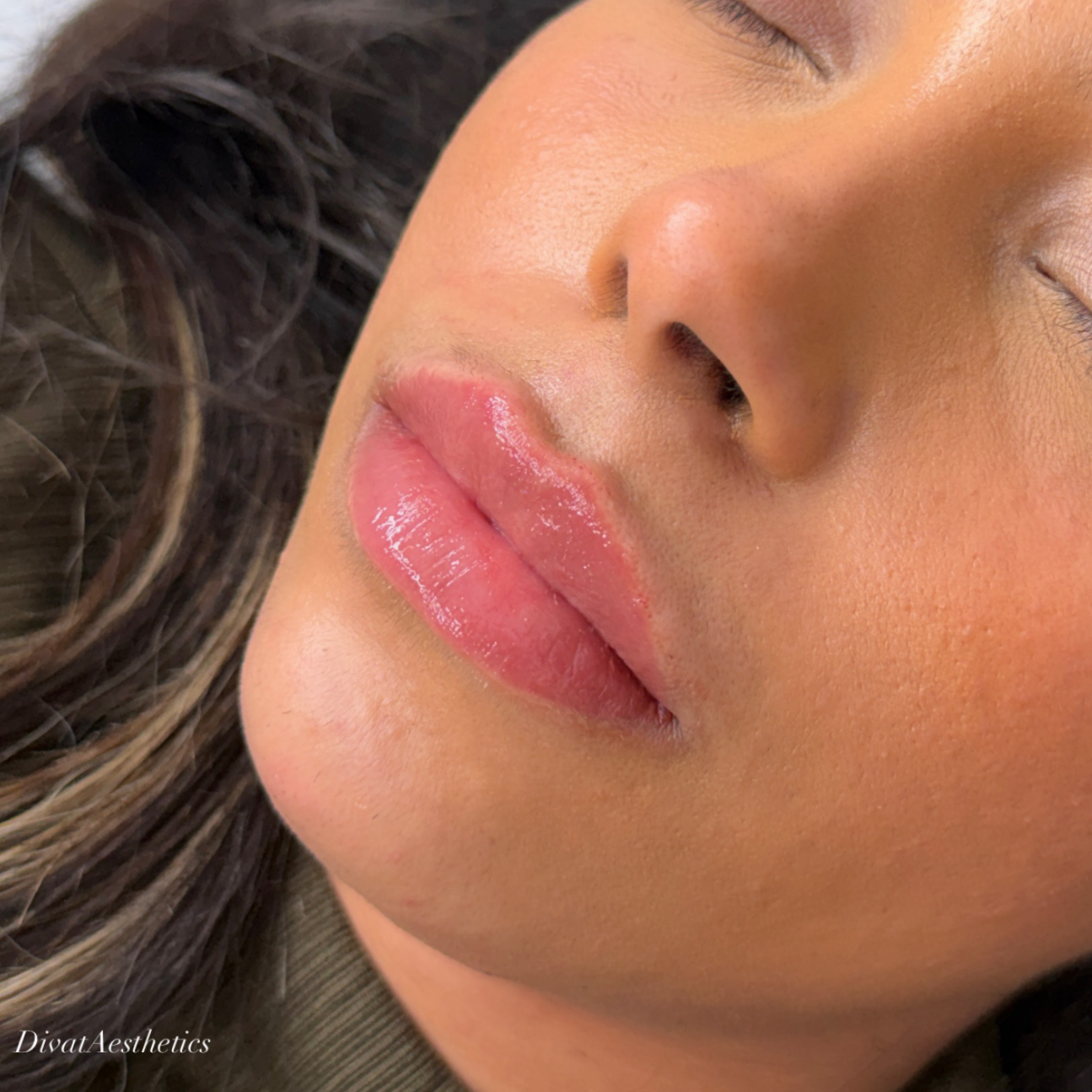 Russian / Natural Lip Filler