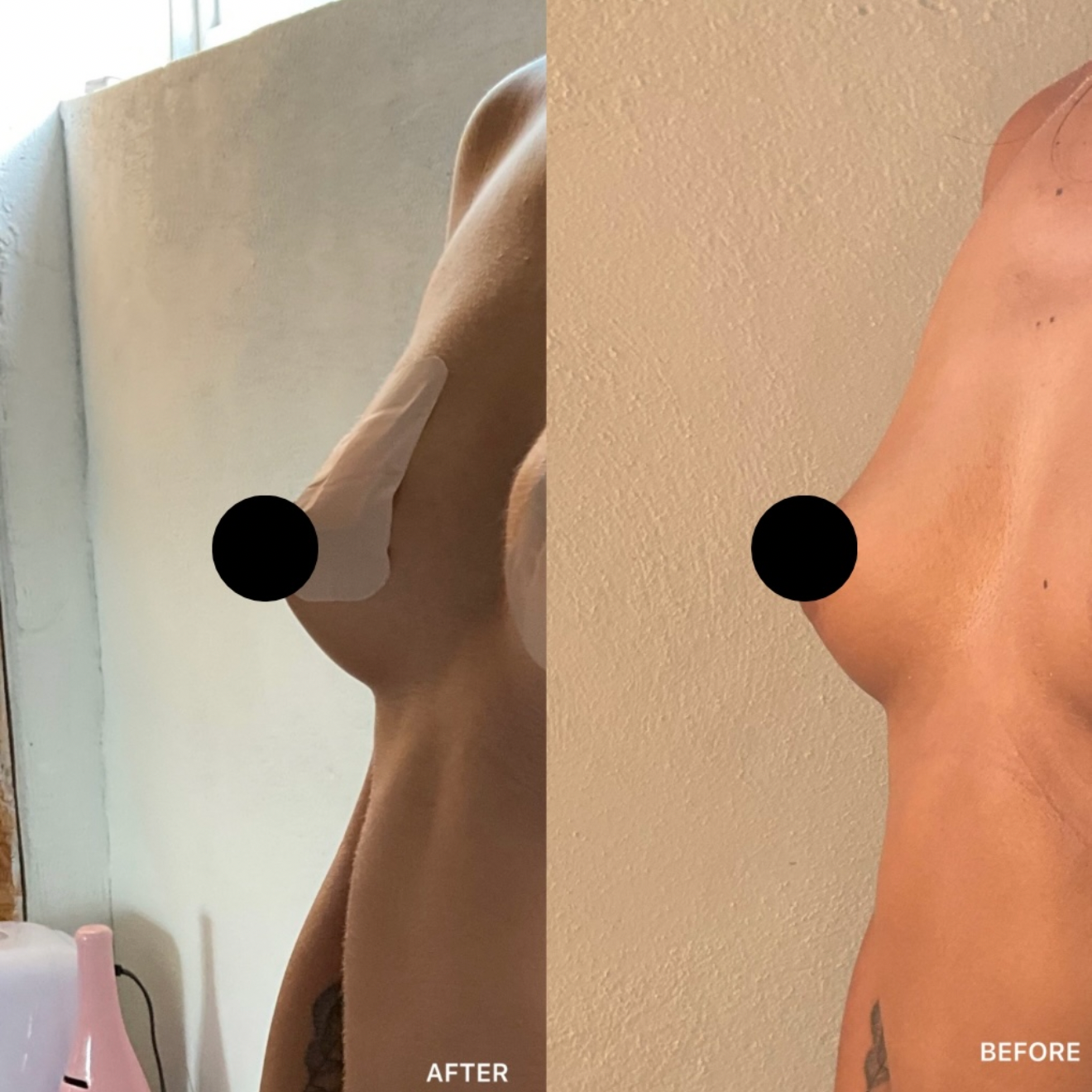 Breast Filler