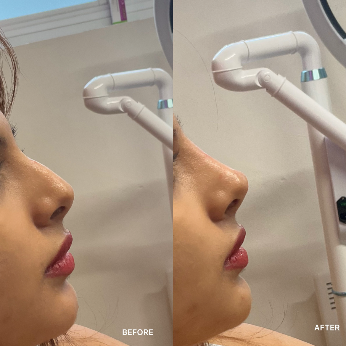 Non-Surgical Rhinoplasty