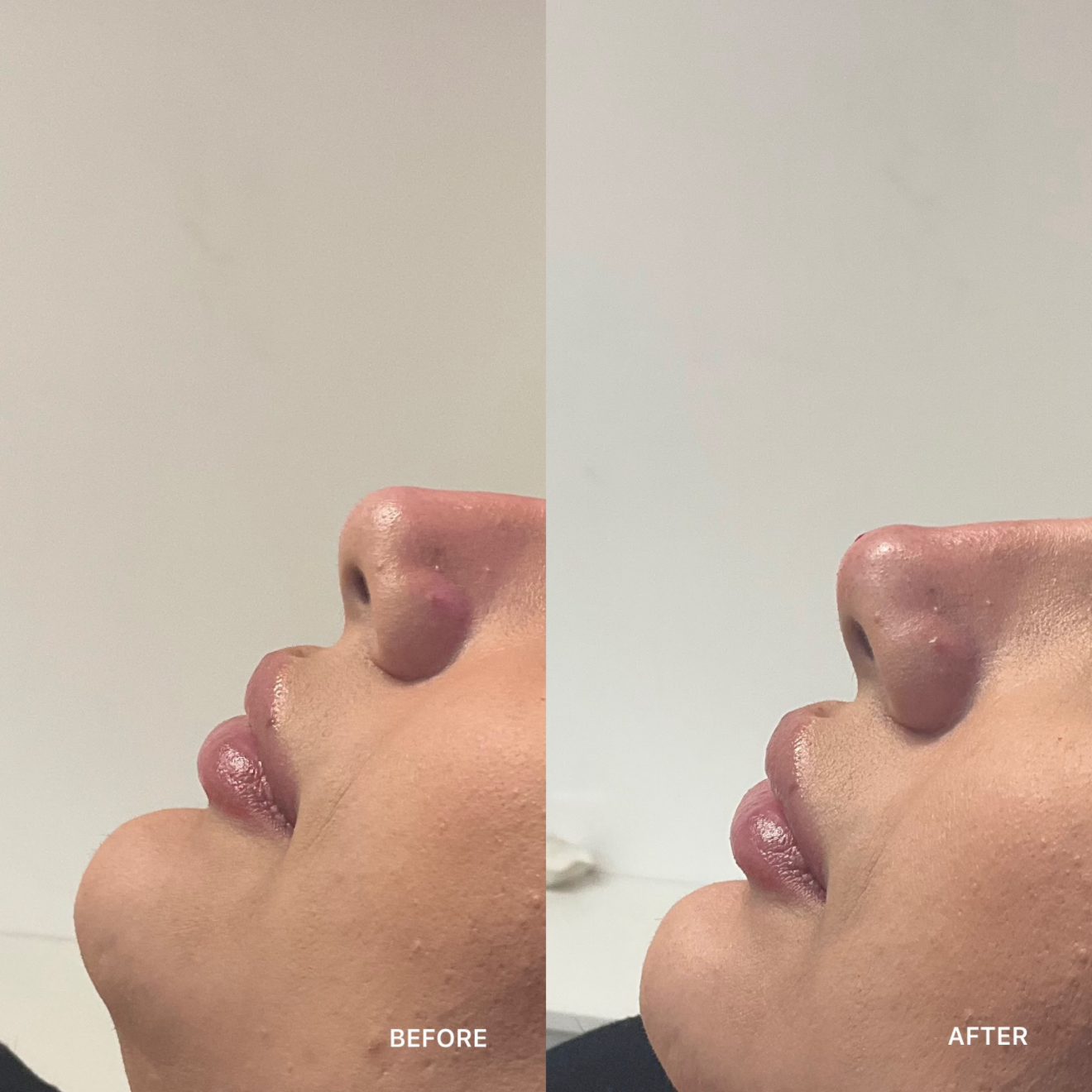 Non-Surgical Rhinoplasty